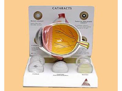 Cataract eye model"